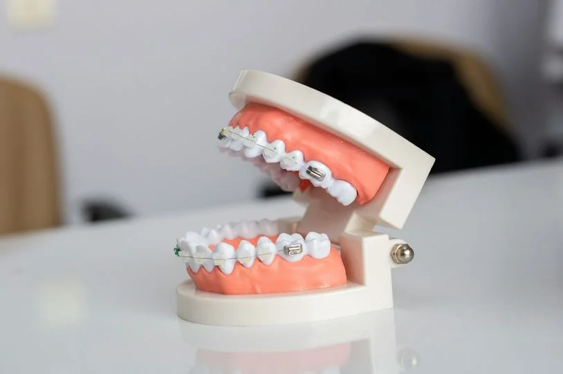 Image of a mold of teeth with braces on